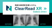 胸部X線読影支援システム　『ClearRead XR』