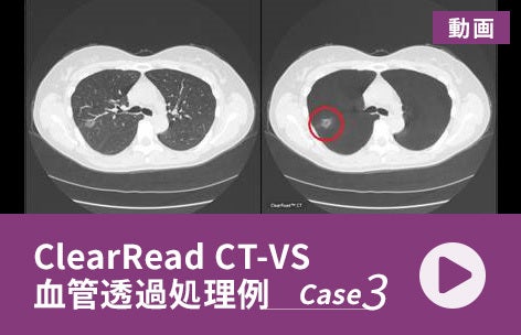 ClearRead CT-VS 血管透過処理例＜3＞