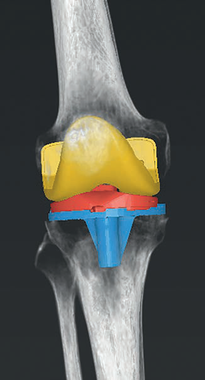 整形外科3Dデジタルプランニングツール 『mediCAD Knee 3D』 Knee3D 例2