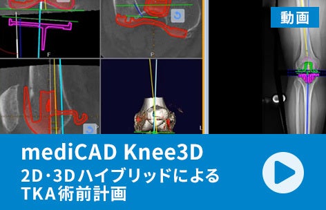 mediCAD Knee3D - 2D･3DハイブリッドによるTKA術前計画