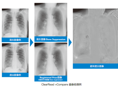 胸部X線経時差分処理システム 『ClearRead +Compare』 