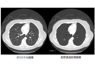 胸部CT読影支援システム