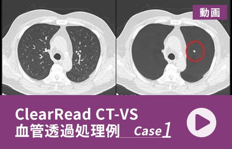ClearRead CT-VS血管透過処理例