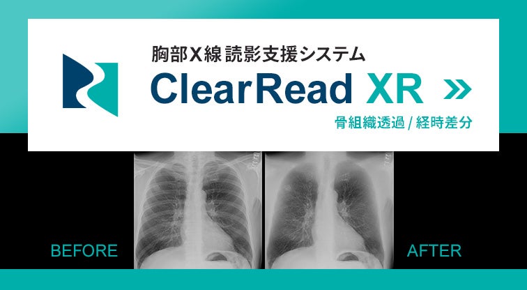 胸部CT読影支援システム　ClearRead XR