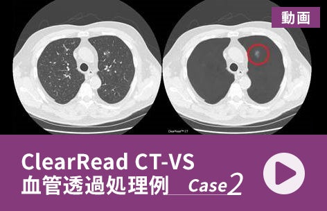 ClearRead CT-VS画像処理例【Case 2】
