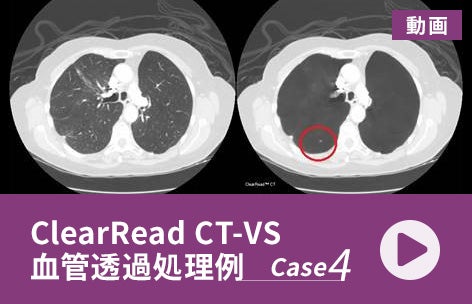 ClearRead CT-VS画像処理例【Case 4】