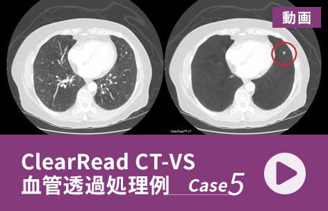 ClearRead CT-VS画像処理例【Case 5】